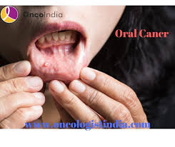 Oral Cancer Get It Detected And Cured Now Health Beauty Fitness Service In Kalyan Nagar Bangalore Click In