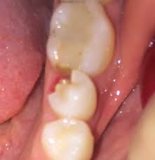Check spelling or type a new query. Broken Tooth To Gumline Do I Need To See A Dentist Asap And Can It Be Fixed Without Extraction Photo