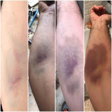 According to the world health organization (who), bruising after a blood draw typically heals quickly. When The Nurse Doesn T Apply Pressure After A Blood Test Day 1 4 Mildlyinfuriating