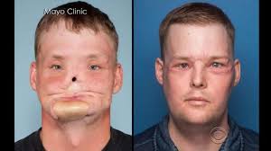 After Face Transplant Wow Amazing Outcome Facial Reconstruction Surgery Face Facial Surgery