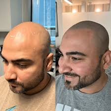 Scalp Micropigmentation in Clinton, MD