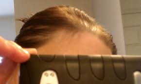 spironolactone for hair loss photo