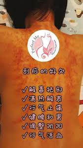 Include (or exclude) self posts. èƒŒéƒ¨åˆ®ç—§å¥½å¤„ä¸€ æ´»è¡€ç¥›ç˜€ Perfect Space Beauty Facebook