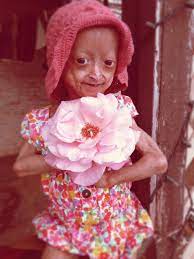 Adalia Rose Is A 8 Year Old Battling With A Disease That Makes The Body Age Quicker Than It Normally Should Yet Sh Shave Her Head Beautiful Children Beautiful