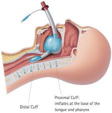 Image result for Extraglottic Device