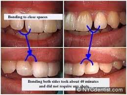 Bonding Gaps Between Teeth With High Cosmetic Dentistry Veneers Cosmetic Dentistry Dental Cosmetics