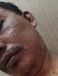 Chickenpox is caused by the contagious varicella virus and mainly affects children. Chickenpox Waktu Tua Satu Kifarah