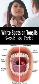 Smoking and chewing tobacco are the biggest risk factors for this condition. White Spots On Tonsils Should You Panic Swollen Tonsils Hair Food Infographic Health