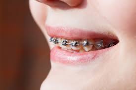 Untuk jenis bracket ini pengikatnya menggunakan karet. 5 Jenis Kawat Gigi Behel Yang Bisa Anda Pilih Hello Sehat
