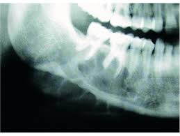 Aneurysmal bone cyst (abc) infrequently occurs within the upper cervical vertebrae. A Digital Manual For The Early Diagnosis Of Oral Neoplasia