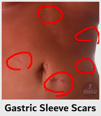 Laparoscopic technique typically results in small scars, reduced pain, and faster recovery times. Gastric Sleeve Scars Guide To Reduce Scarring Quickly