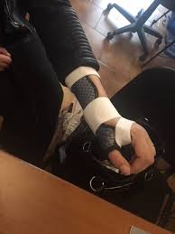 Specialiste Des Ortheses Thermoformees Pour Fracture En Motte De Beurre A Allauch Et Chateau Gombert Centre De L Orthopedie Et Du Bien Etre A Marseille Centre De L Orthopedie Et Du Bien Etre