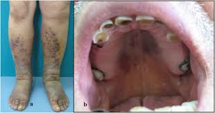 The skin lesions are usually painless, purple and may be flat or raised. Classic Kaposi S Sarcoma A Review Of 156 Cases Sciencedirect
