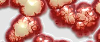 However, screening tests typically are not recommended for mesothelioma for people considered not at increased risk for it. Mesothelioma Brain Metastasis Mesothelioma Net