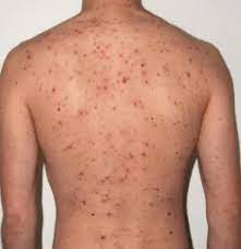 The strongest risk factor for developing skin cancer is ultraviolet (uv) ray exposure, typically from the sun. Skin Cancer Causes Risk Factors Prevention And Treatment