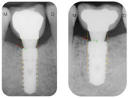 Check spelling or type a new query. Ijerph Free Full Text A Radiographic And Clinical Comparison Of Immediate Vs Early Loading 4 Weeks Of Implants With A New Thermo Chemically Treated Surface A Randomized Clinical Trial Html