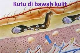 Kudis buta atau scabies memang sukar dirawat, tetapi kudis kalau kena pada cara yang betul, kudis buta boleh hilang dengan. Kudis Buta Pada Kanak Kanak Untuk Hilangkan Rasa Gatal Mengeyam Dibadan Cantikseri