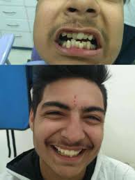 Top Teeth Whitening Services in Jind