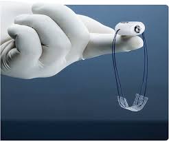 Adjustable Midurethral Slings In The Treatment Of Female Stress Urinary Incontinence Intechopen