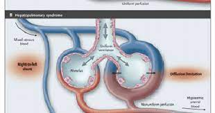 Medicine Decoded Platypnea Orthodeoxia