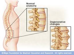 Bone Spurs On Spine Bone Spurs Shoulder Bone Spur Shoulder Bones