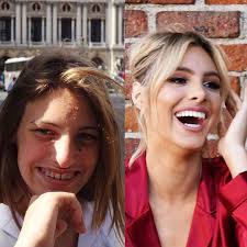 Instagram Model Lele Pons Shows What Plastic Surgery Can Achieve Wow Gallery Face Plastic Surgery Celebrity Plastic Surgery Plastic Surgery