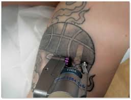 In this article we are going to review some faq's on removing tattoos tattoo removal is a procedure that needs some thought before diving in. Laser Tattoo Removal Aesthetic Center Lewes Delaware