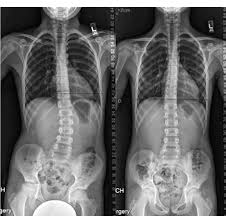 Image result for Functional Leg Length Discrepancy