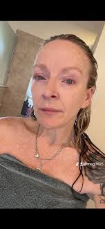 Relief after breast implant removal surgery