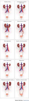 Genetic Environmental And Epigenetic Factors Involved In Cakut Nature Reviews Nephrology