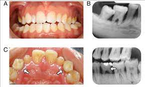 Oral Health In Individuals With Down Syndrome Intechopen