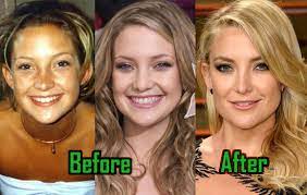 We did not find results for: Kate Hudson Plastic Surgery Boob Job Nose Job Before After Photos Celebritysurgeryicon