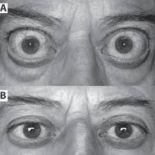 A Preoperative Appearance Of Our Patient With Exophthalmos