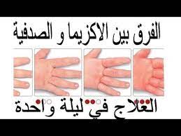 الفرق بين الاكزيما و الصدفية و وصفة للعلاج في ليلة واحدة youtube thumb holding hands