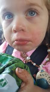 Dogs getting stung by yellow jackets and bee sting treatment