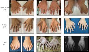 Image result for Polydactyly