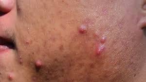 We did not find results for: What Are The Symptoms Of Different Types Of Acne Everyday Health