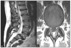 Image result for Low Back Imaging