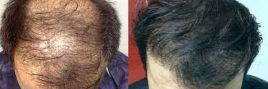 Donato zizi impegnato nella chirurgia della calvizie dal 1999, è stato uno dei primi medici in . Autotrapianto Di Capelli Fut Fue Evitare La Calvizie