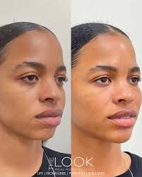 ✨ Subtle Enhancements, Stunning Results! ✨ Sometimes, the smallest tweaks  make the BIGGEST impact! 🤩 For this beauty, we focused on: 💉 Chin  enhancement for better projection and balance. 💉 Subtle filler