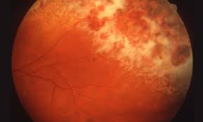 Image result for HIV Retinitis