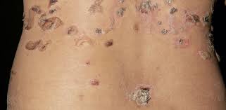 Blasen An Haut Und Schleimhaut Steckt Ein Immundefekt Dahinter Doctors Today