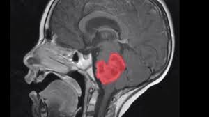 Keep in mind, headaches are not usually early warning signs, but can occur once a tumor has reached a considerable size. What Is Dipg Abbie S Army