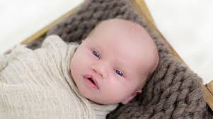 Image result for Cleft Lip