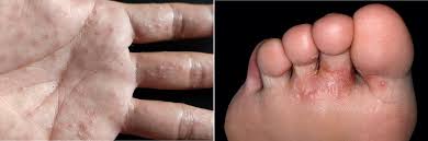 Image result for pompholyx soles of feet