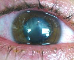 Image result for Eye Foreign Body