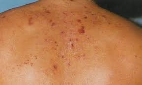 Alergia Cutanea Durante El Embarazo Natalben