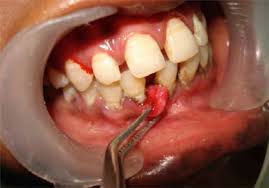 Image result for granuloma gum disease