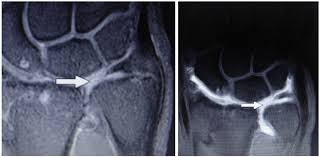 Treatment of injury of the triangular fibrocartilage complex (tfcc). Mri And Mra Suggestive Of Tfcc Injury Respectively Download Scientific Diagram