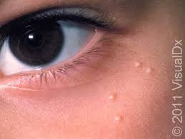Image result for milium cyst on eyelid